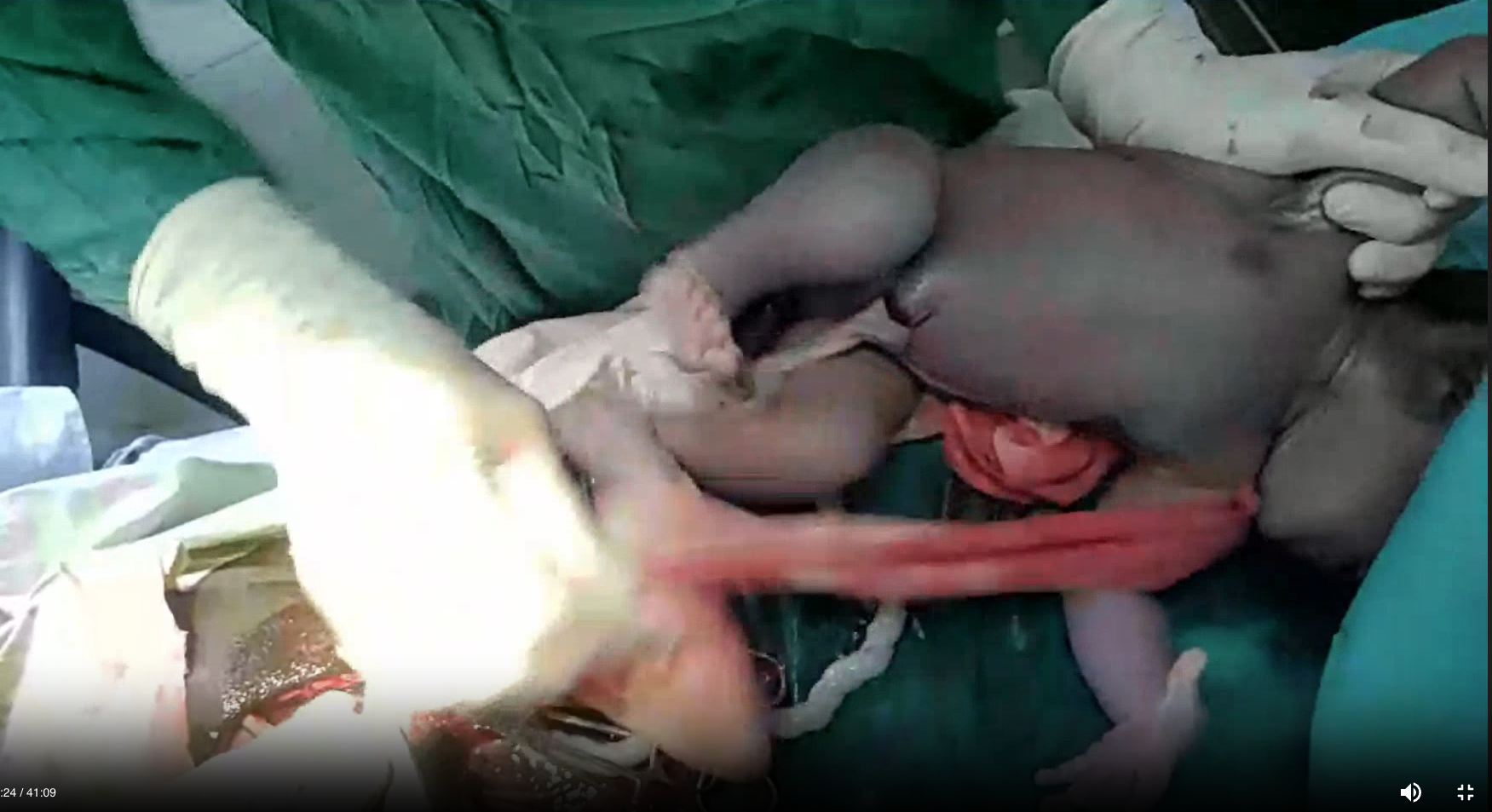 A cesarean section procedure for future training purposes.